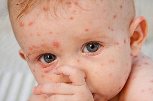 Measles outbreaks are occurring in many parts of the world with low measles vaccination rates